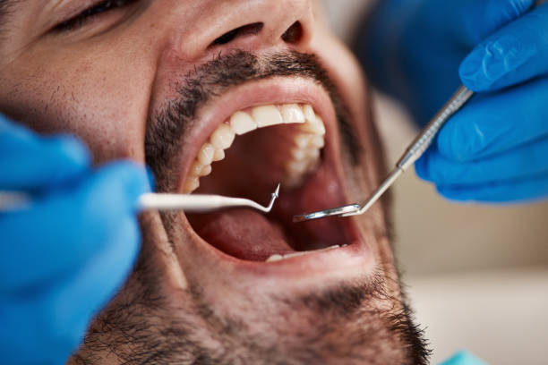 Best Emergency Wisdom Teeth Removal in De Pere, WI