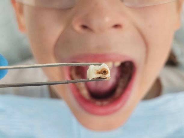 Best Emergency Gum Treatment in De Pere, WI